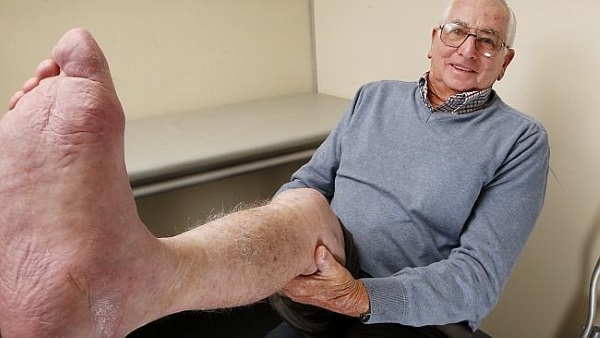 Lekarze użyli drukarki 3D,aby uratować stopę 71-letka walczącego z rakiem1