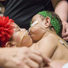 Chirurdzy z Houston rozdzielili 10 miesięczne bliźniaczki syjamskie