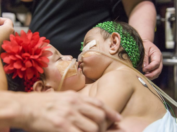 Chirurdzy z Houston rozdzielili 10 miesięczne bliźniaczki syjamskie