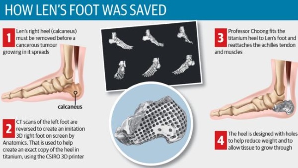 Lekarze użyli drukarki 3D,aby uratować stopę 71-letka walczącego z rakiem2